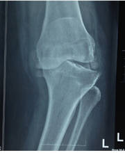 Eight Facts about Primary Knee Replacement Eight Facts about Primary Knee Replacement